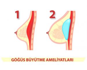 Göğüs Büyütme Ameliyatı Öneriliyor mu?