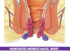 Hemoroid Memesi Nasıl İner?