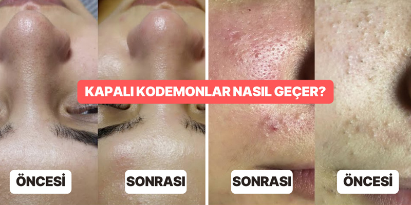 komedon geçirme