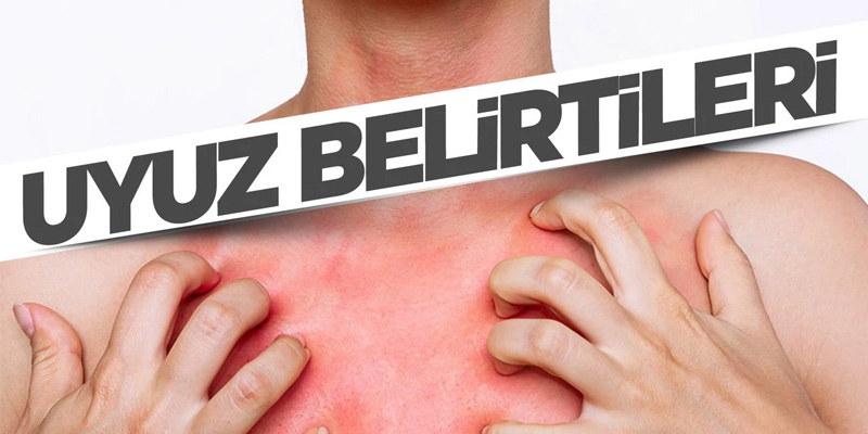 cilt hastalığı olan uyuzun belirtileri uyuz belirtileri